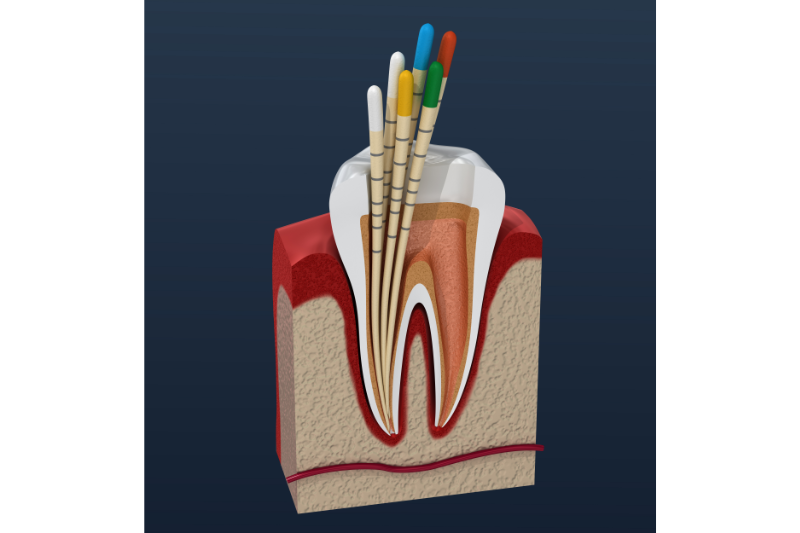 The Basic in Endodontics Step by Step